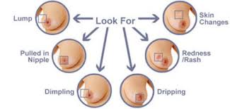 Breast Cancer Develops From Breast Tissue And Cause A Lump In The Breast A Change In Breast Shape Dimpling Of The Skin