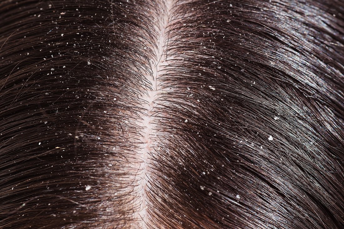 Dandruff-common chronic scalp condition marked by flaking of the skin