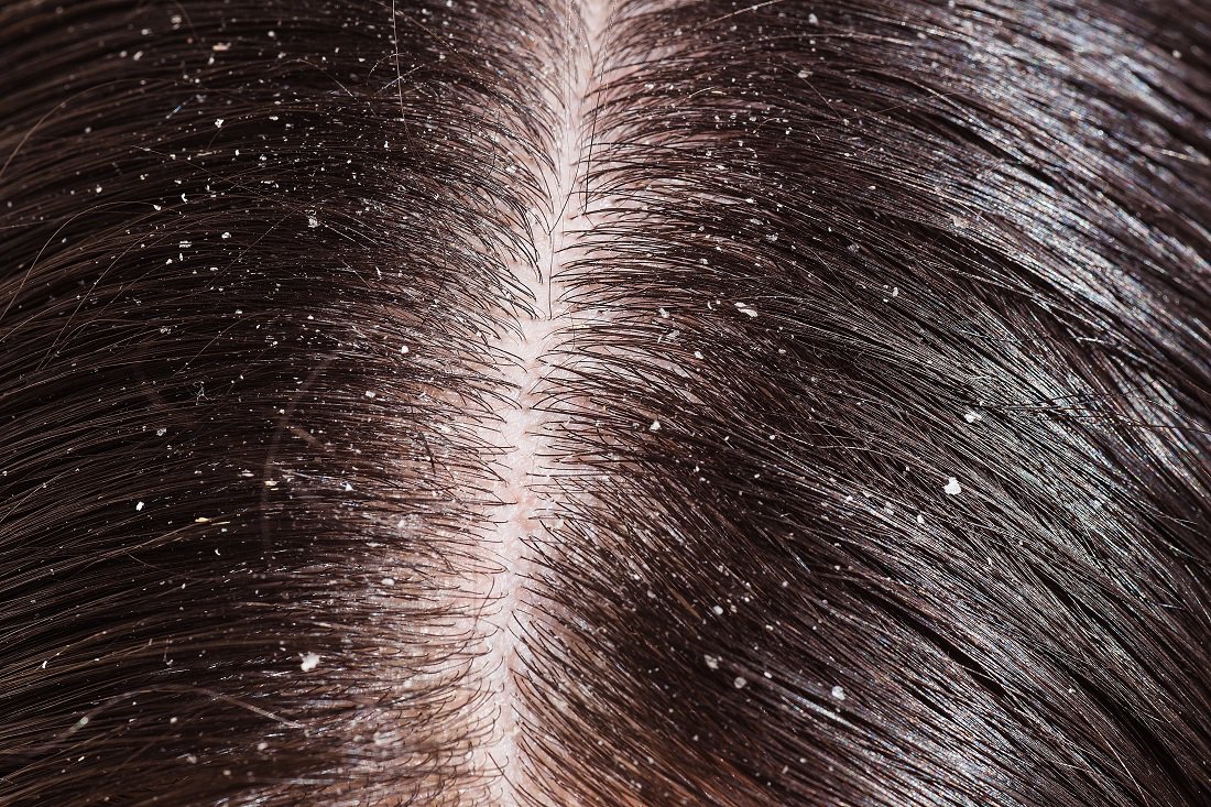 dandruff-common-chronic-scalp-condition-marked-by-flaking-of-the-skin