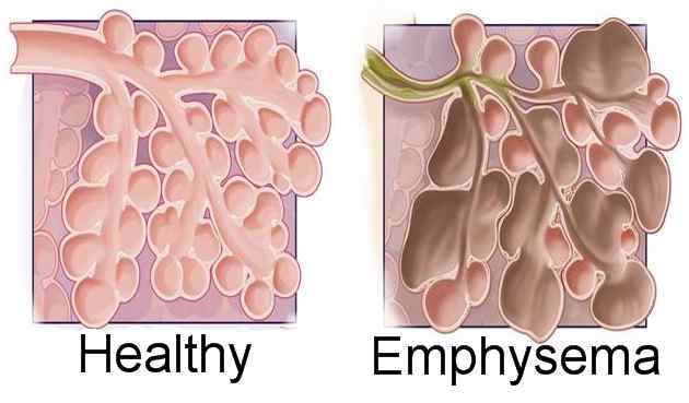 emphysema